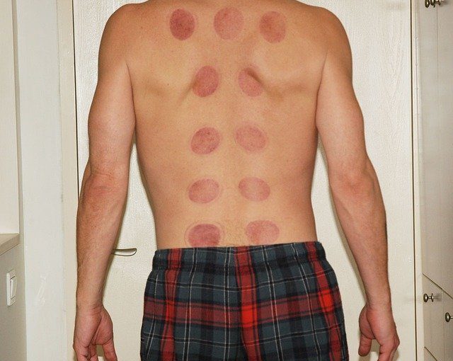 Relieve Your Back Pain With Acupuncture